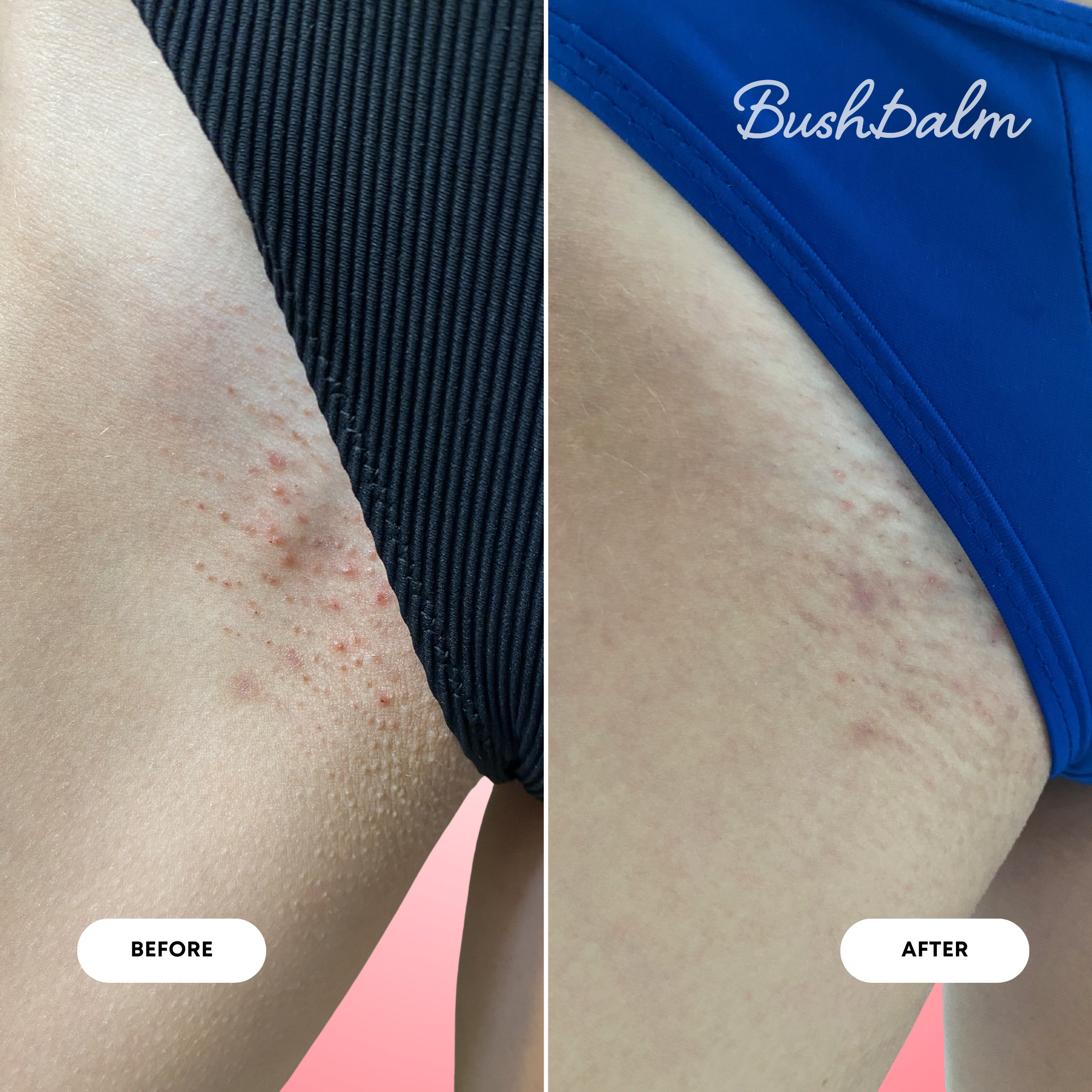2-Step Ingrown Hair Routine - Watermelon Sugar