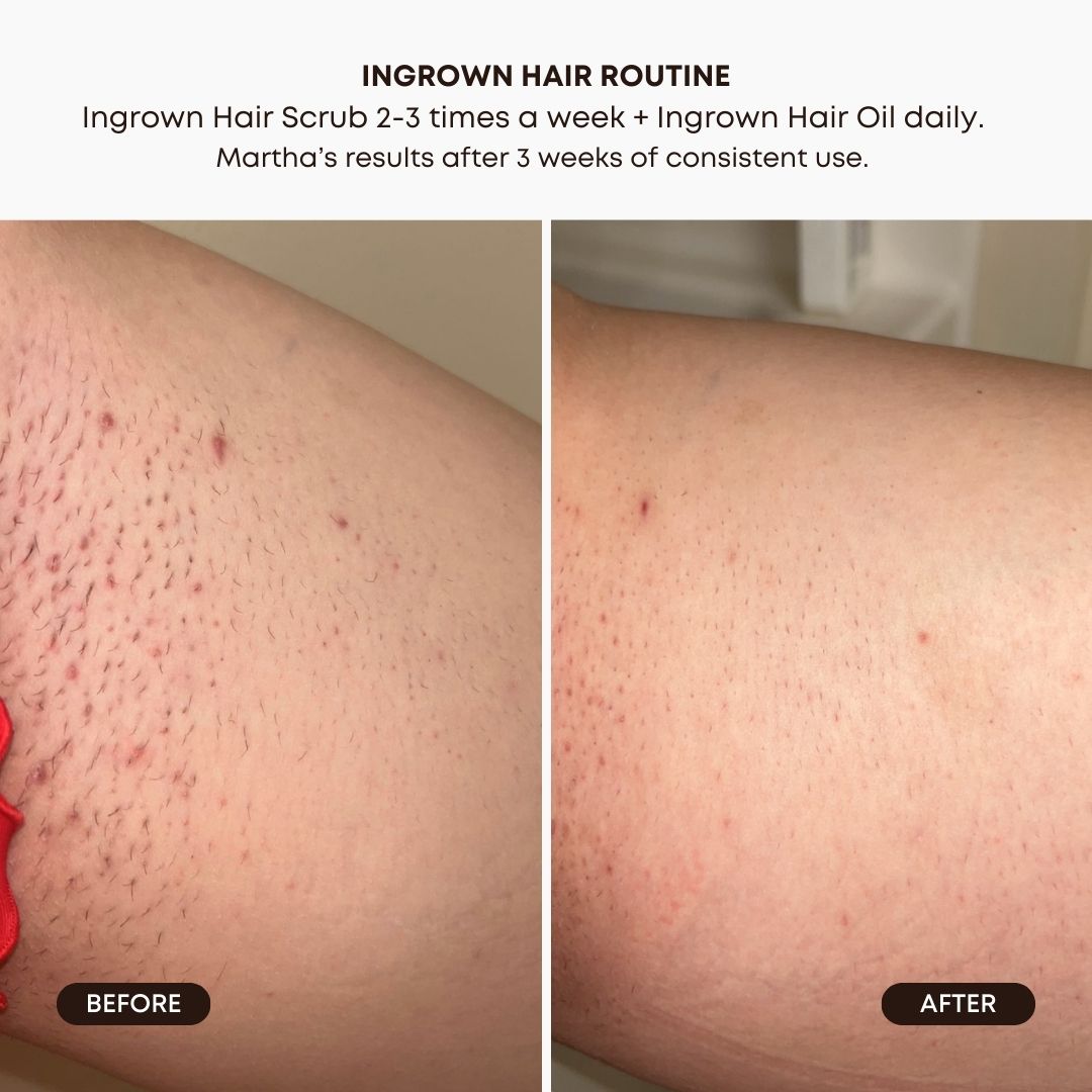 Watermelon Sugar Ingrown Hair 2-Step Routine