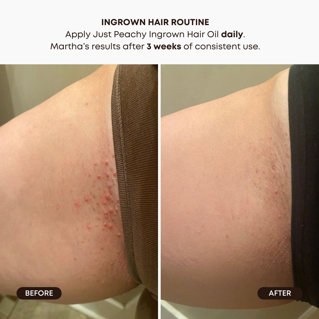 Watermelon Sugar Ingrown Hair 2-Step Routine