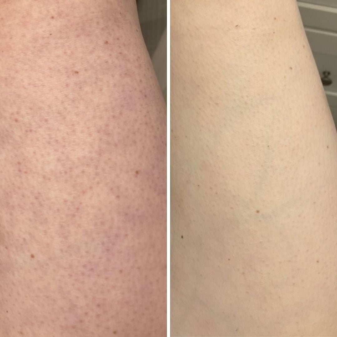 Keratosis Pilaris Before And After keratosis-pilaris-before-and-after