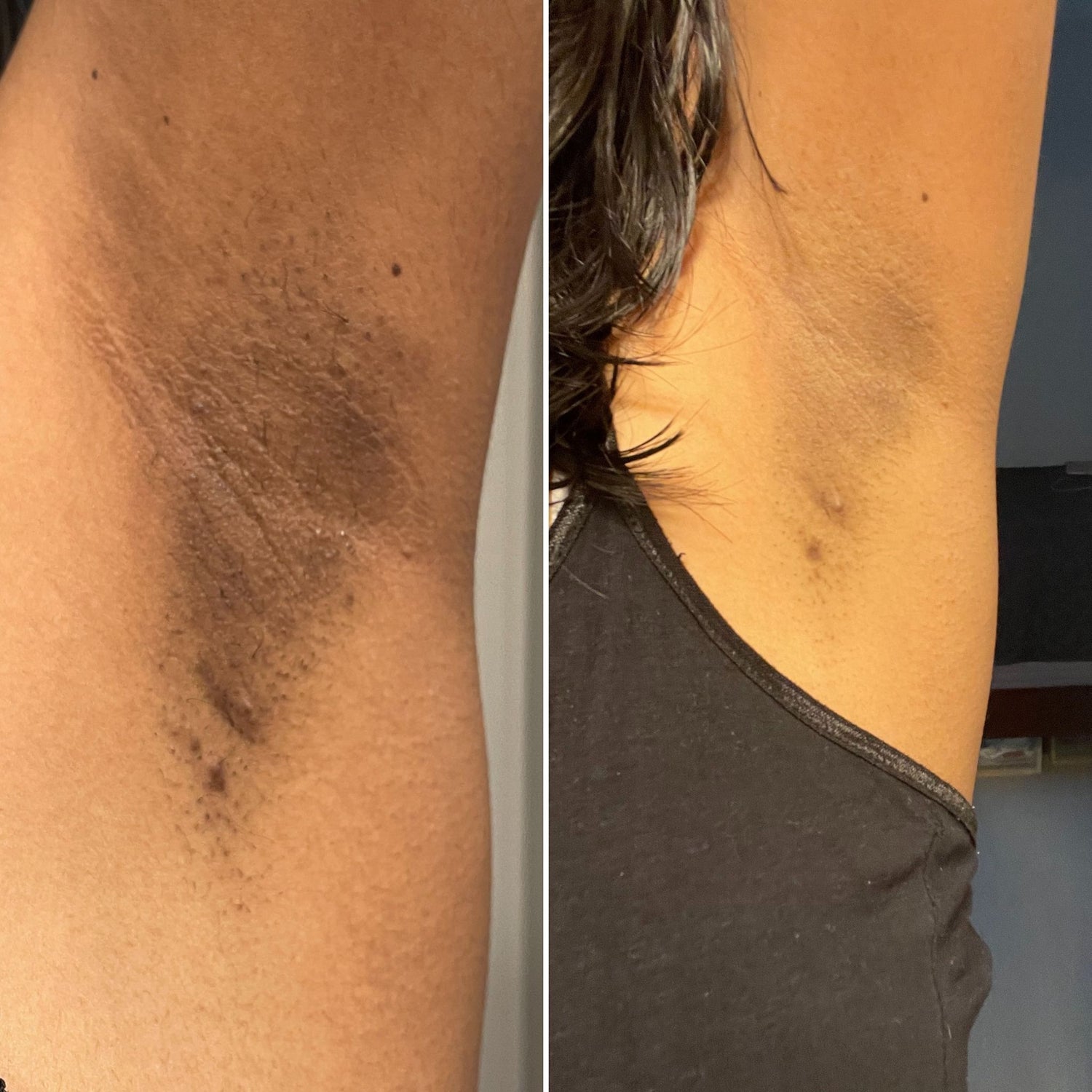 Lightening Underarms with Bushbalm 