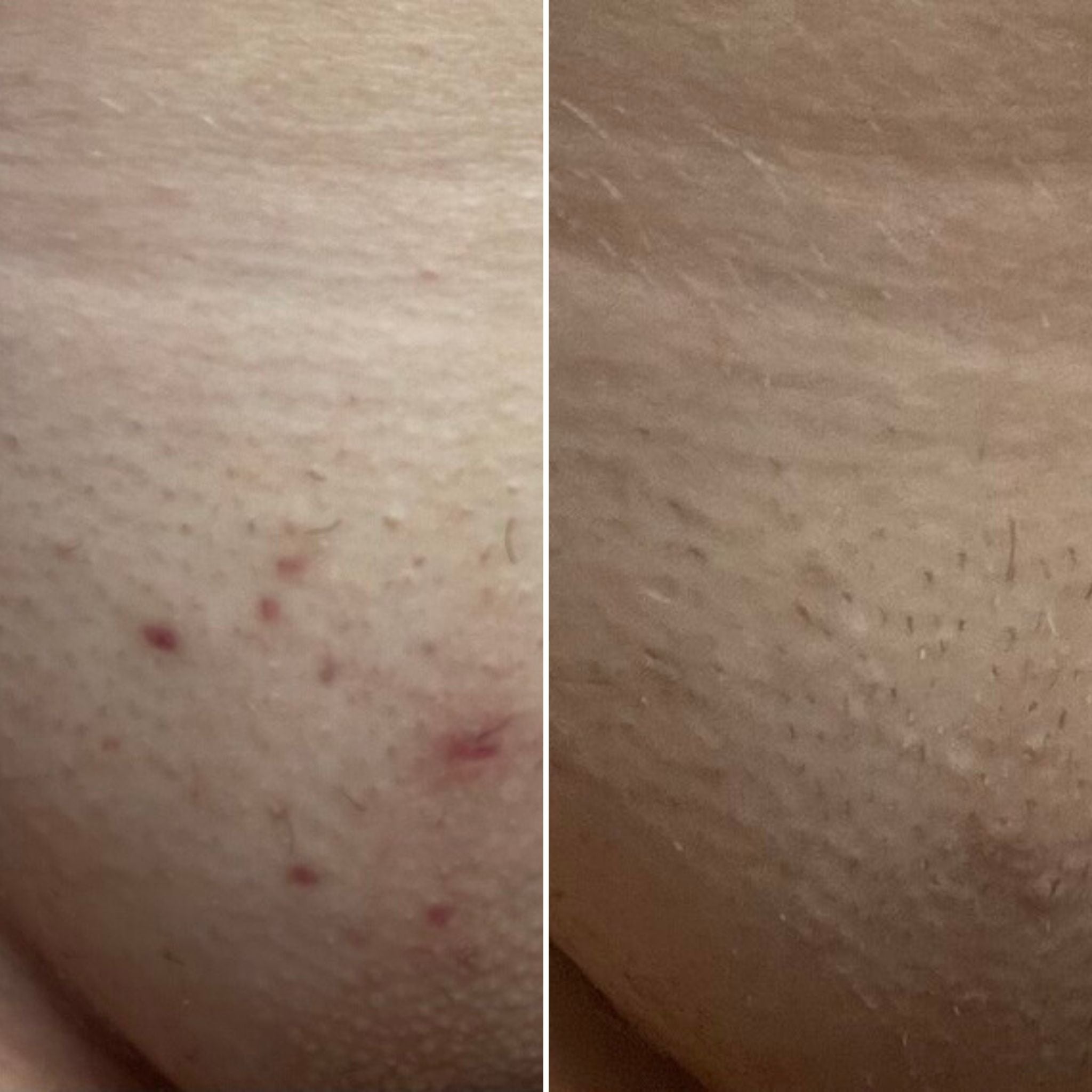 BEfore and after using Bushbalm ingrown hair on thigh