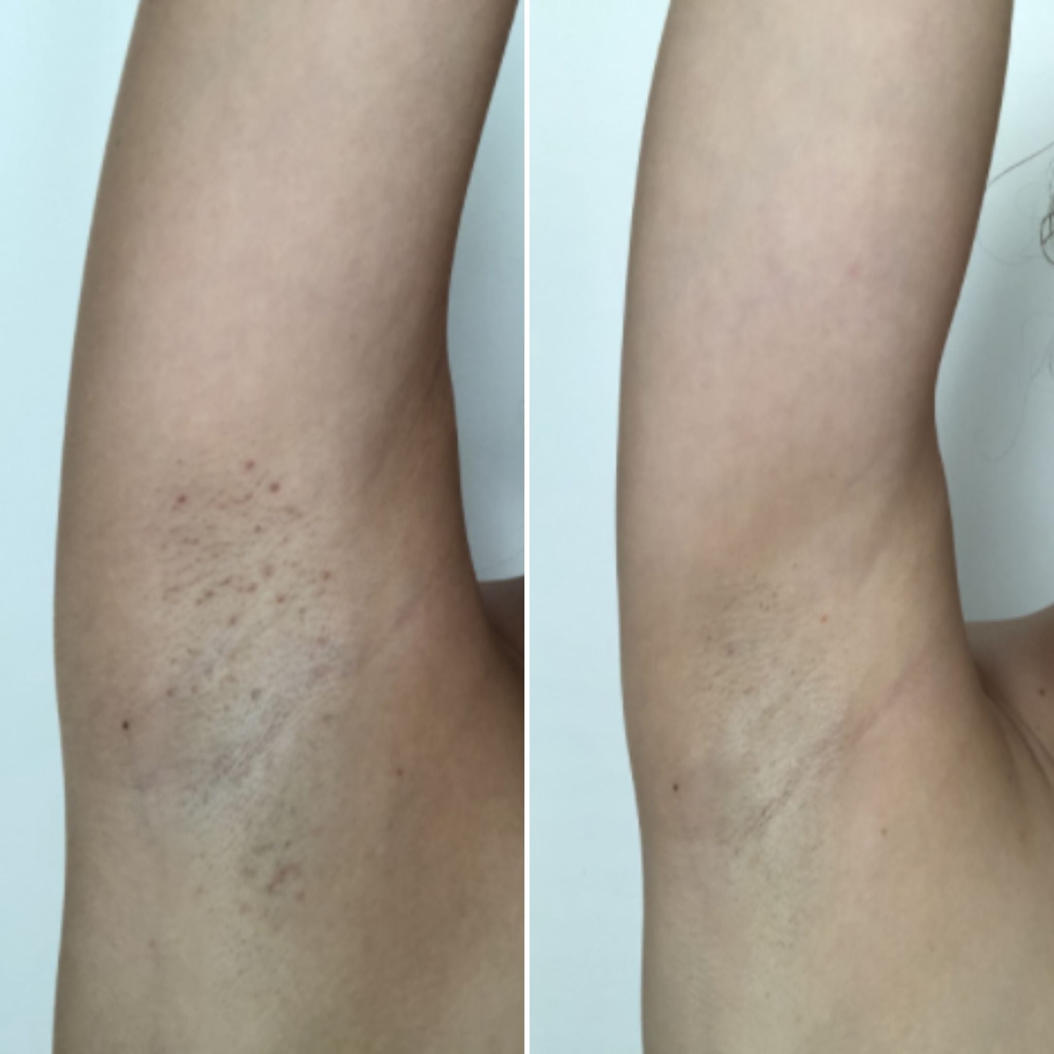 Ingrown Hairs in Armpit Bushbalm Before and After Photos 