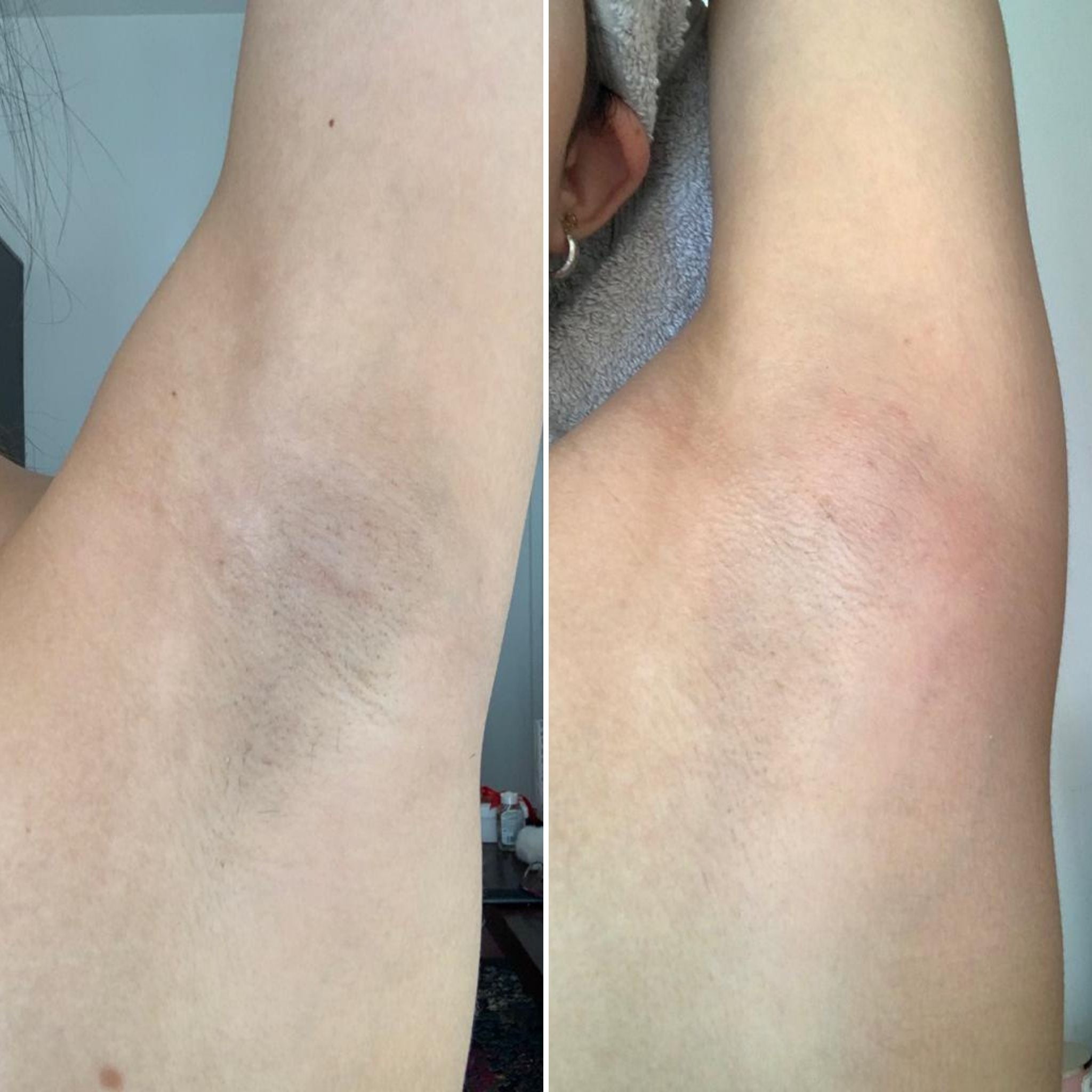 Dark underarms before and after woman white