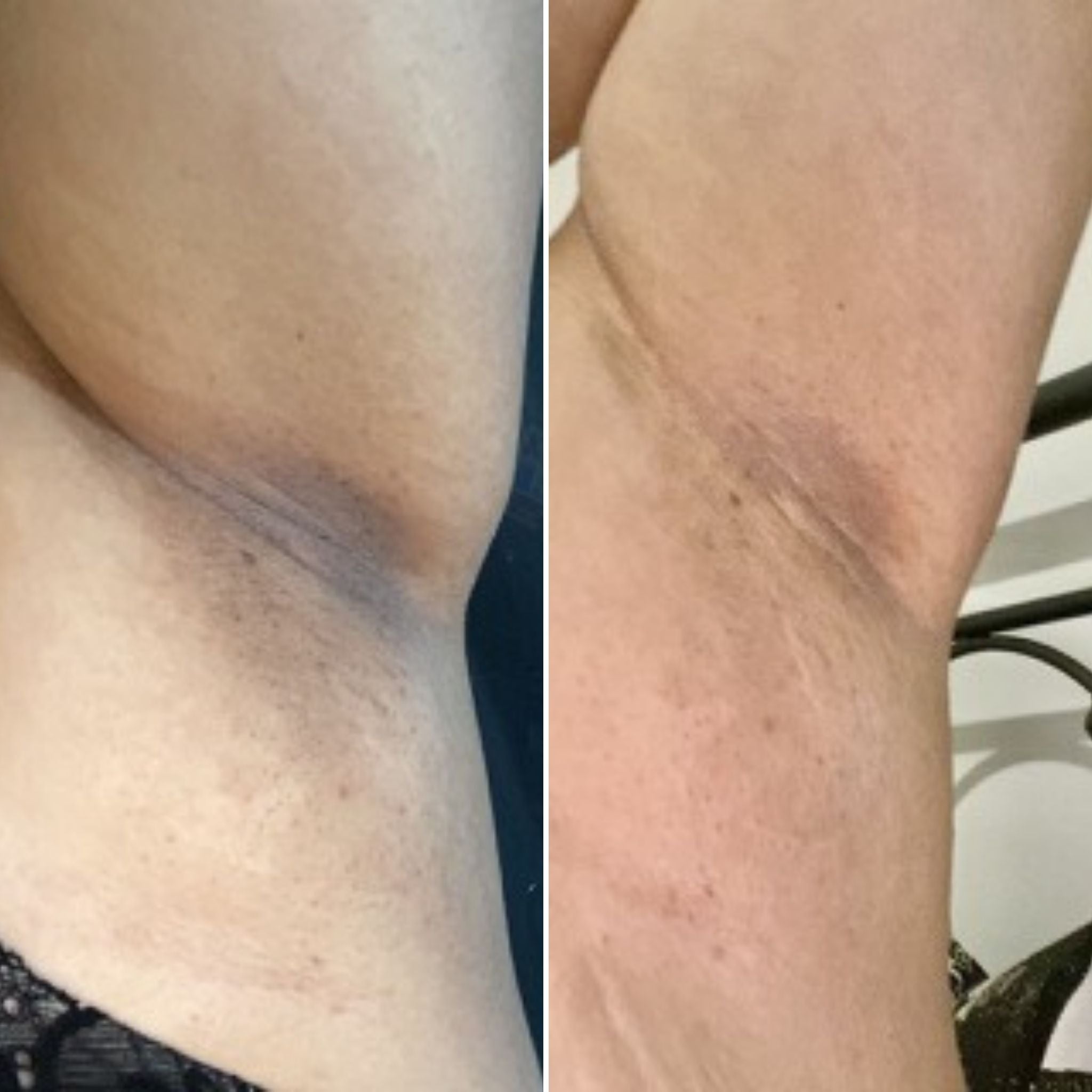 Dark underarms before and after