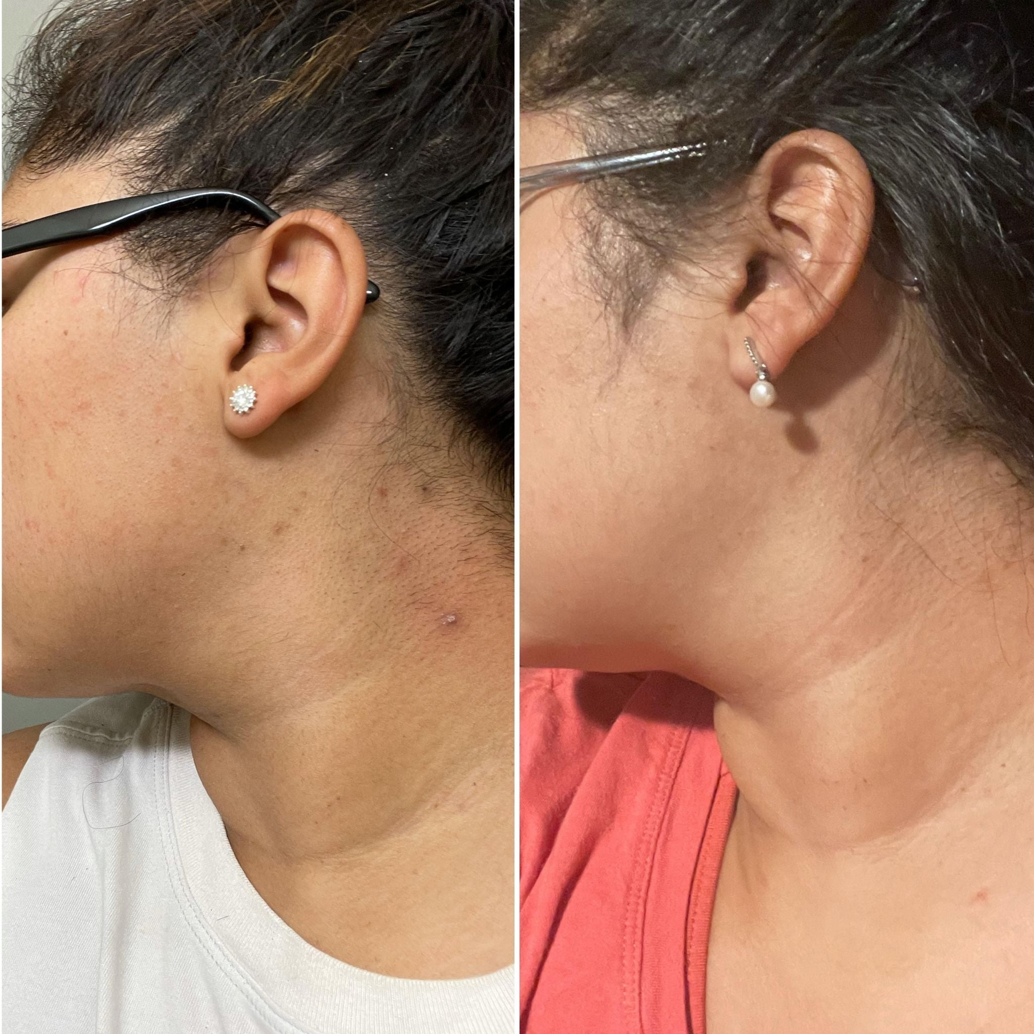 ingrown hair on neck before and after