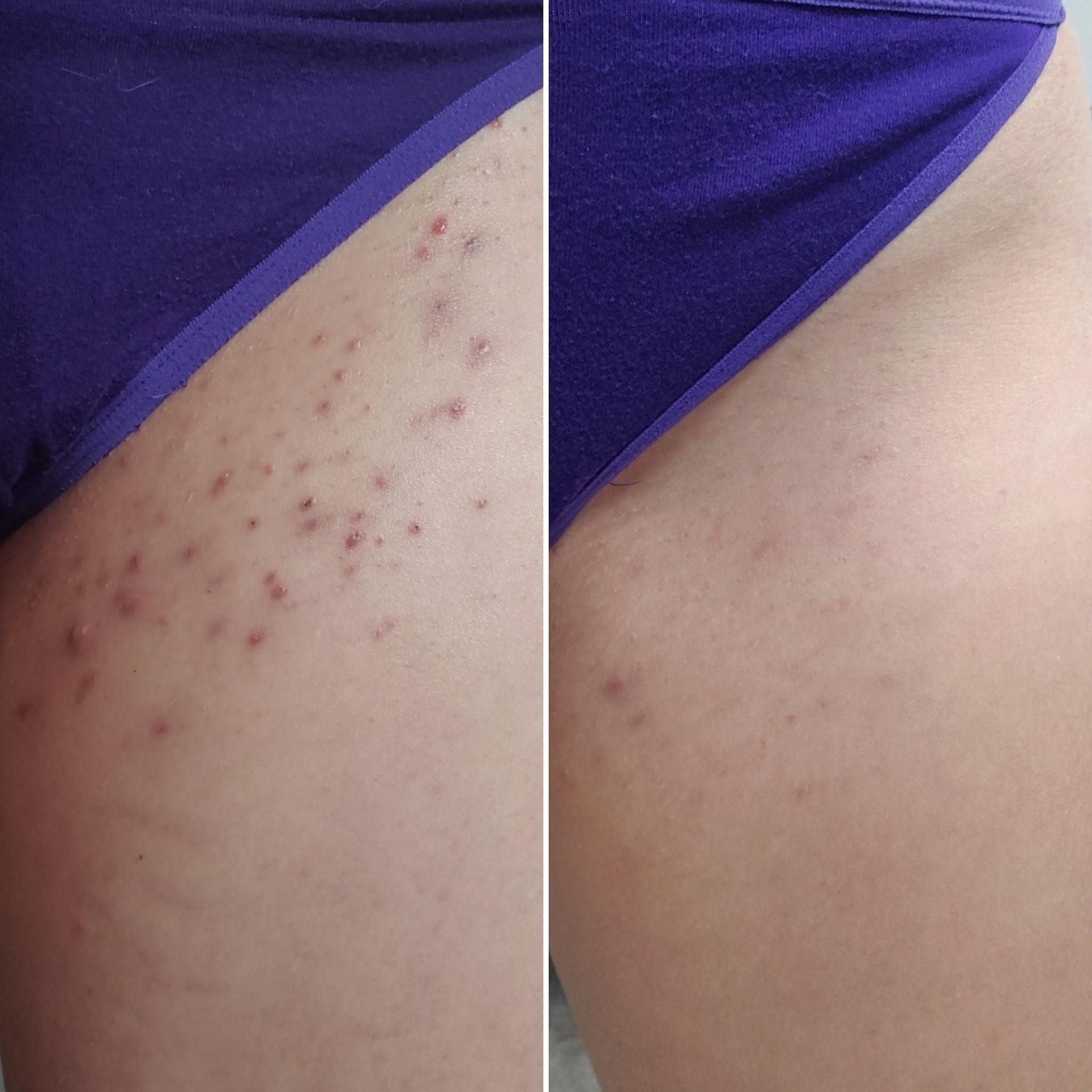 Before and after dark spots on the bikini line down there