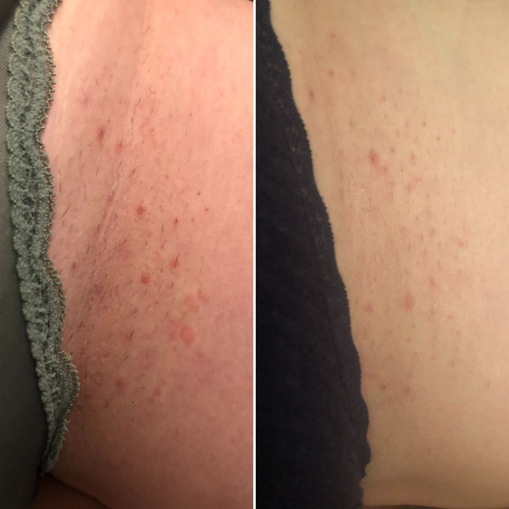 Before and After Bushbalm ingrown hairs