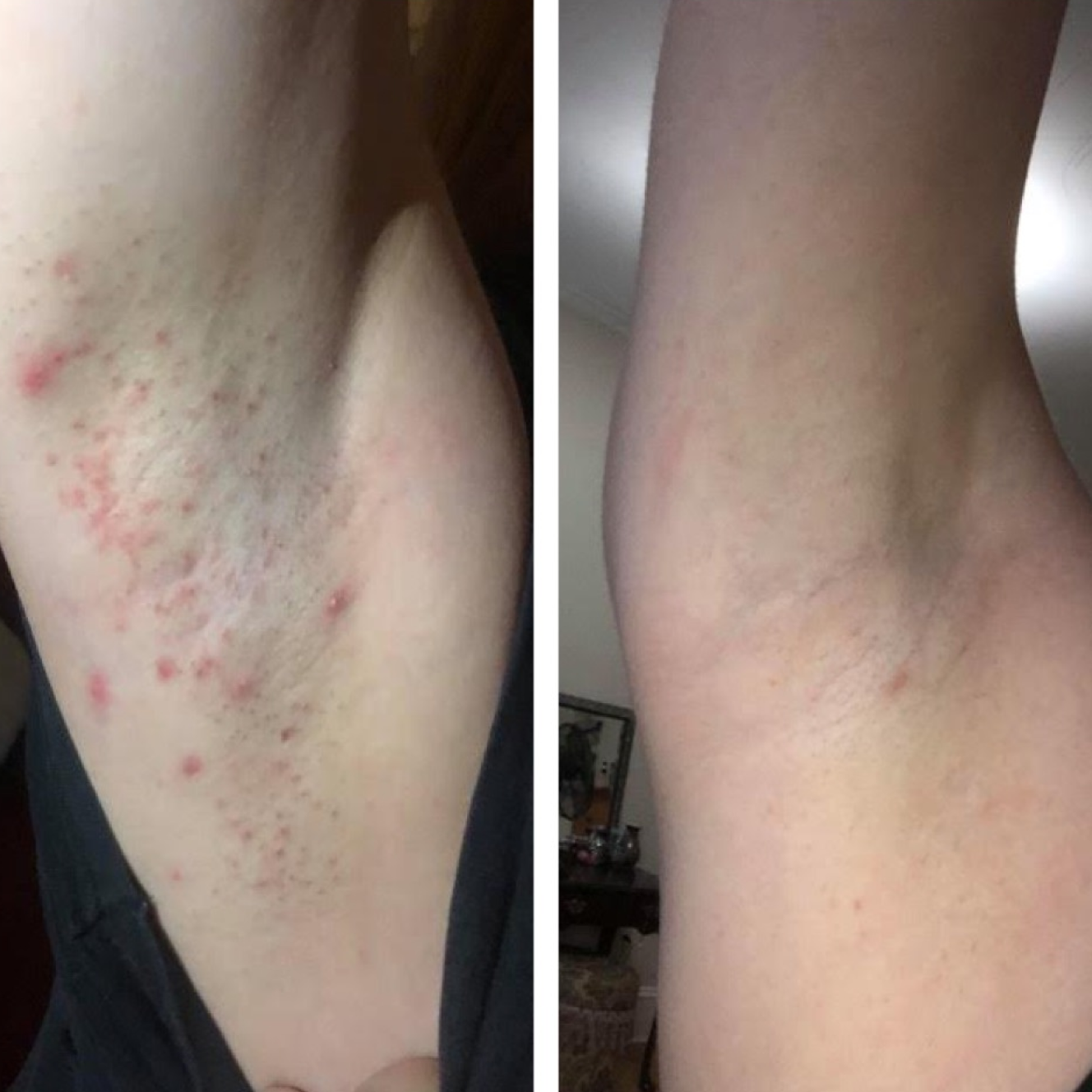 Before & After closeup image Bushbalm itchy ingrown hairs