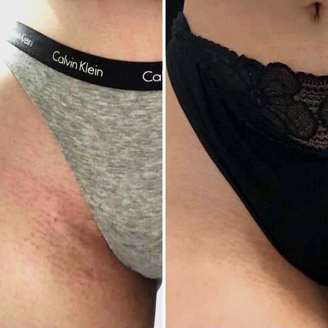 Before & After image closeup Bushbalm