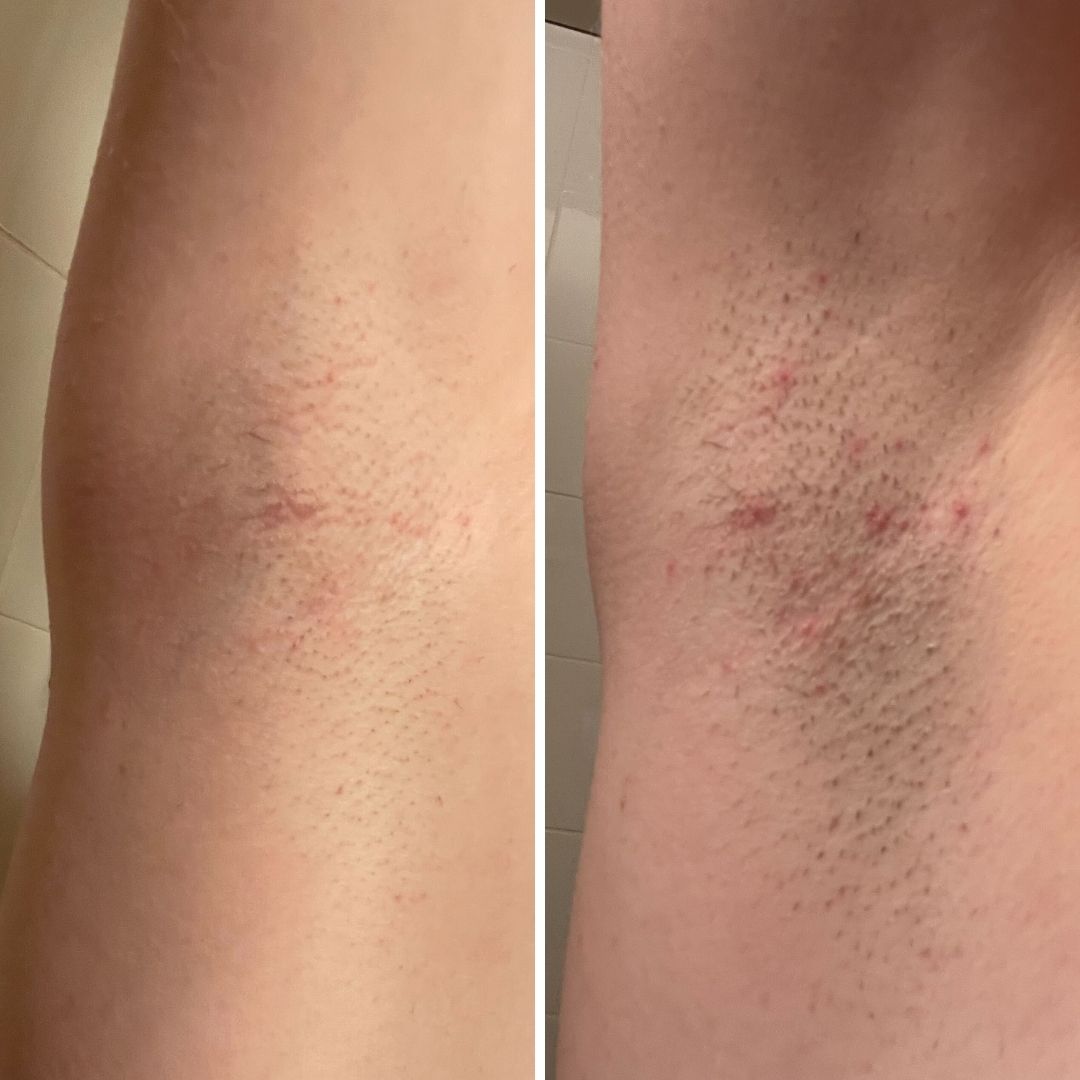 Before & After image closeup Bushbalm ingrown hairs