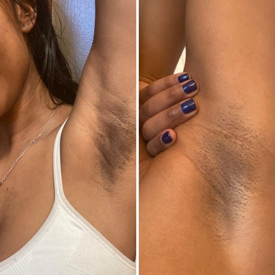 Before & After image closeup Bushbalm hyperpigmentation on underarms