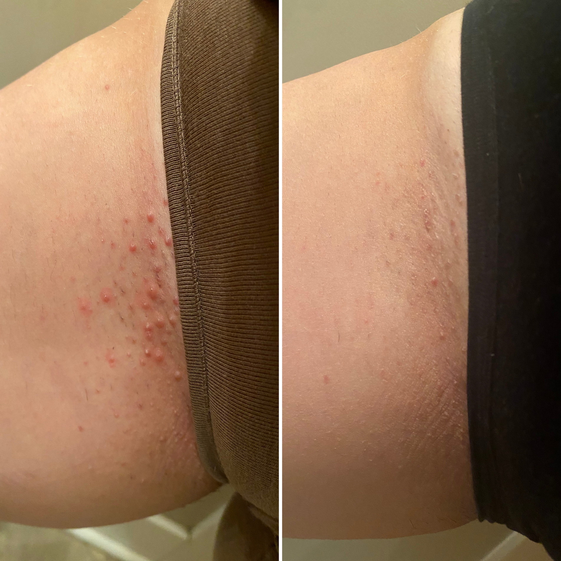 Bikini line before and after, side by side