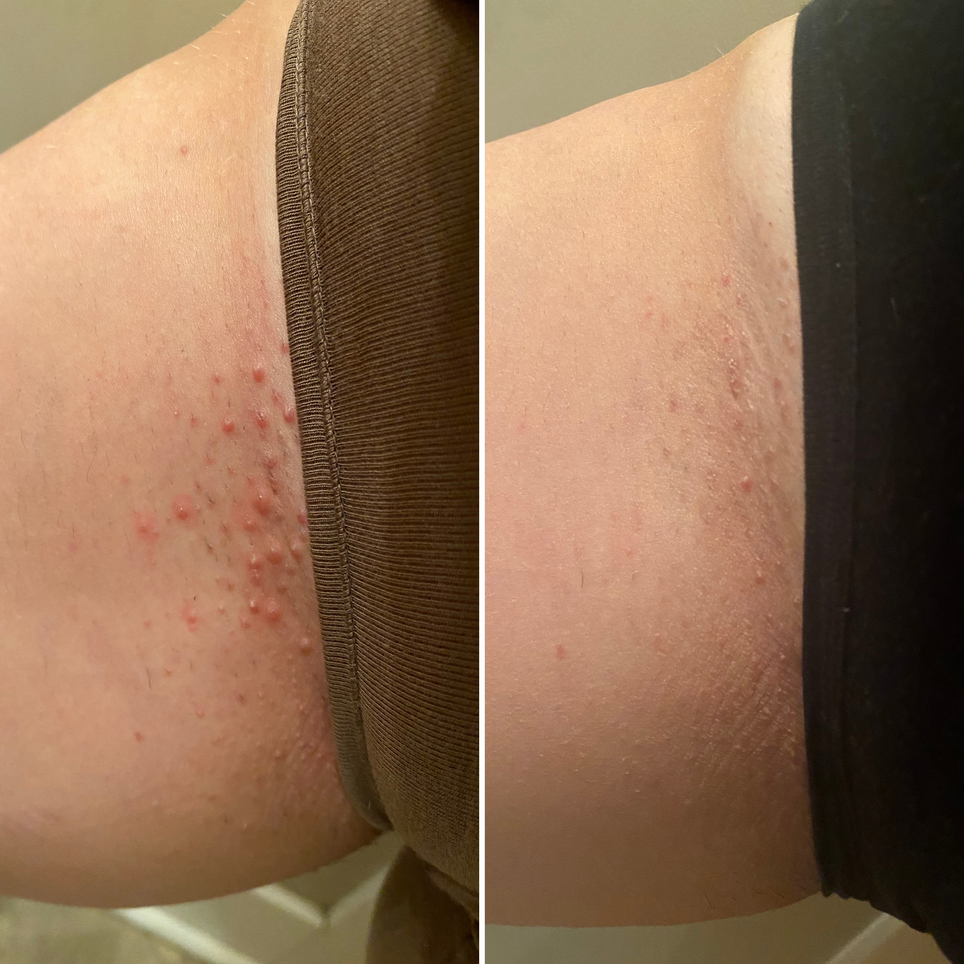 Bikini line before and after, side by side