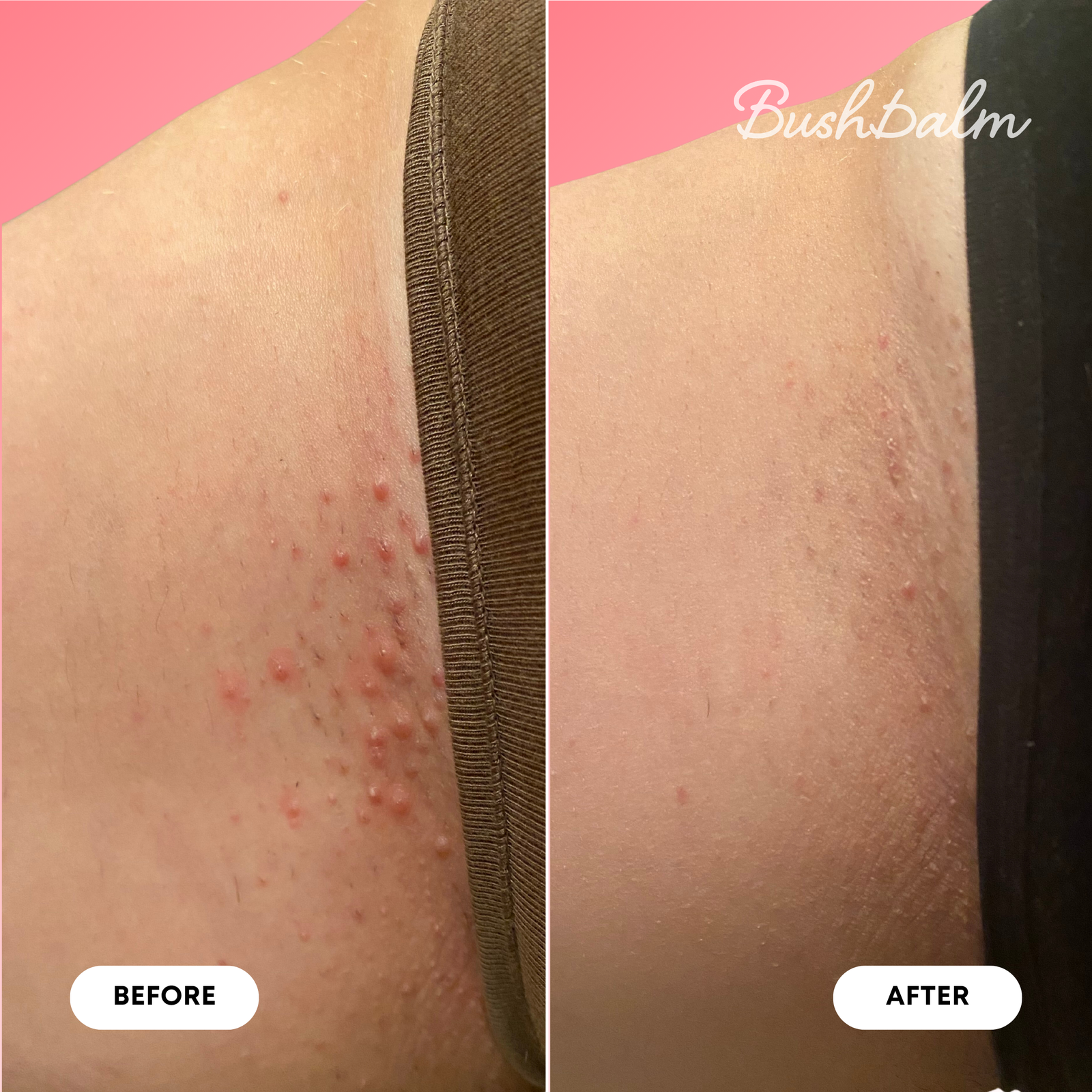 Mini Ingrown Hair Oil - Watermelon Sugar