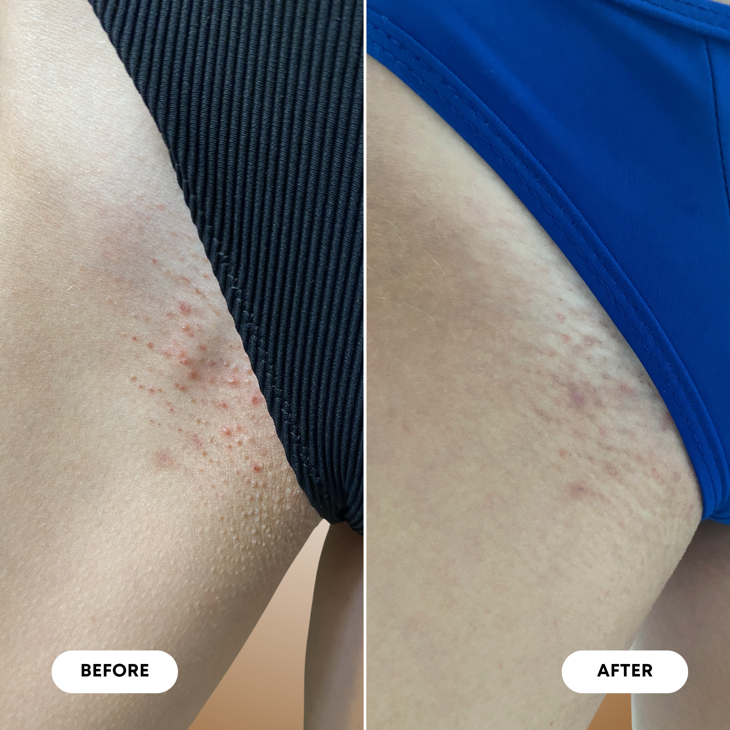 Vanilla Coconut 2-Step Ingrown Hair Routine
