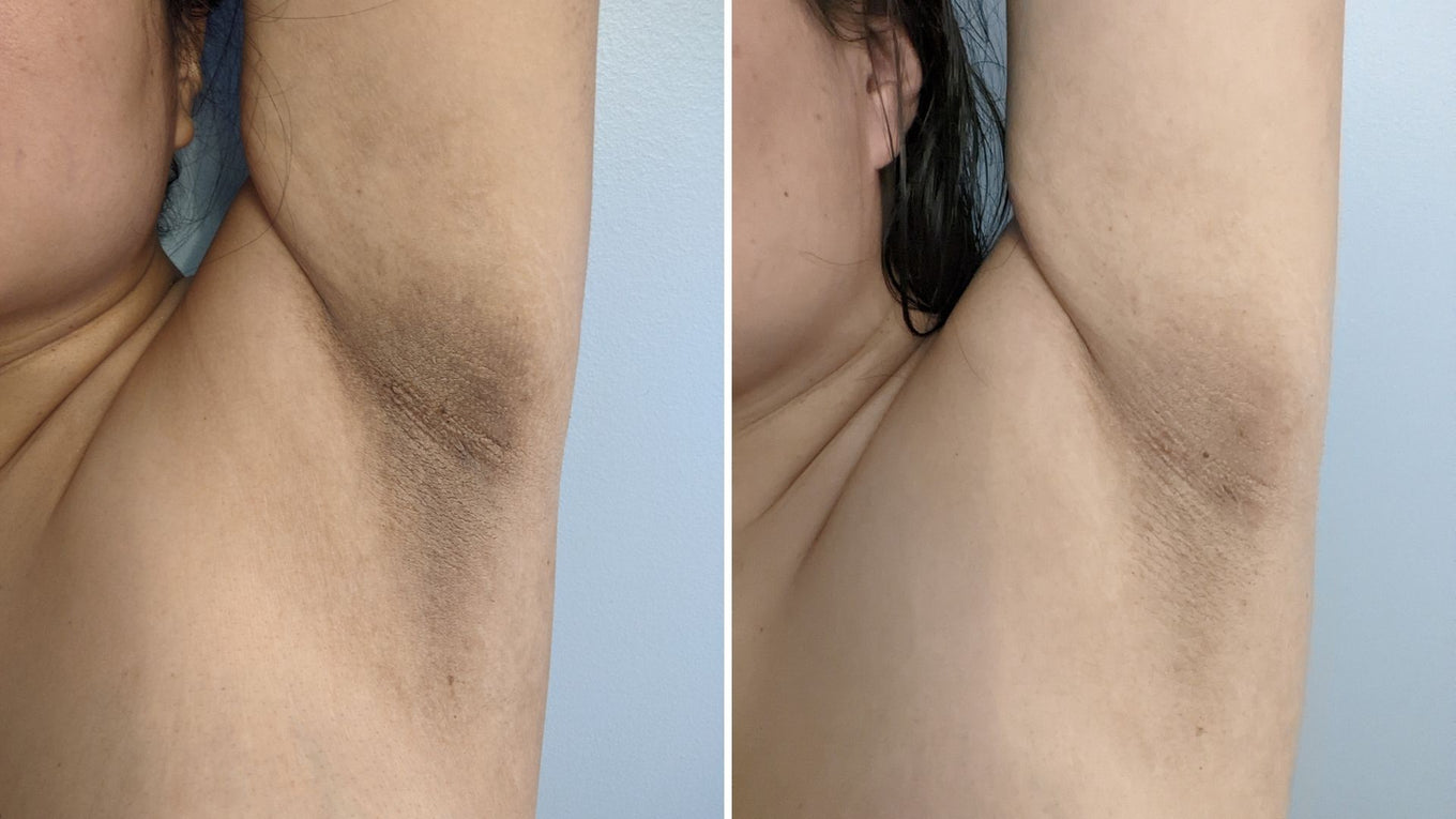 Underarm darkening from acanthosis nigricans before treatment