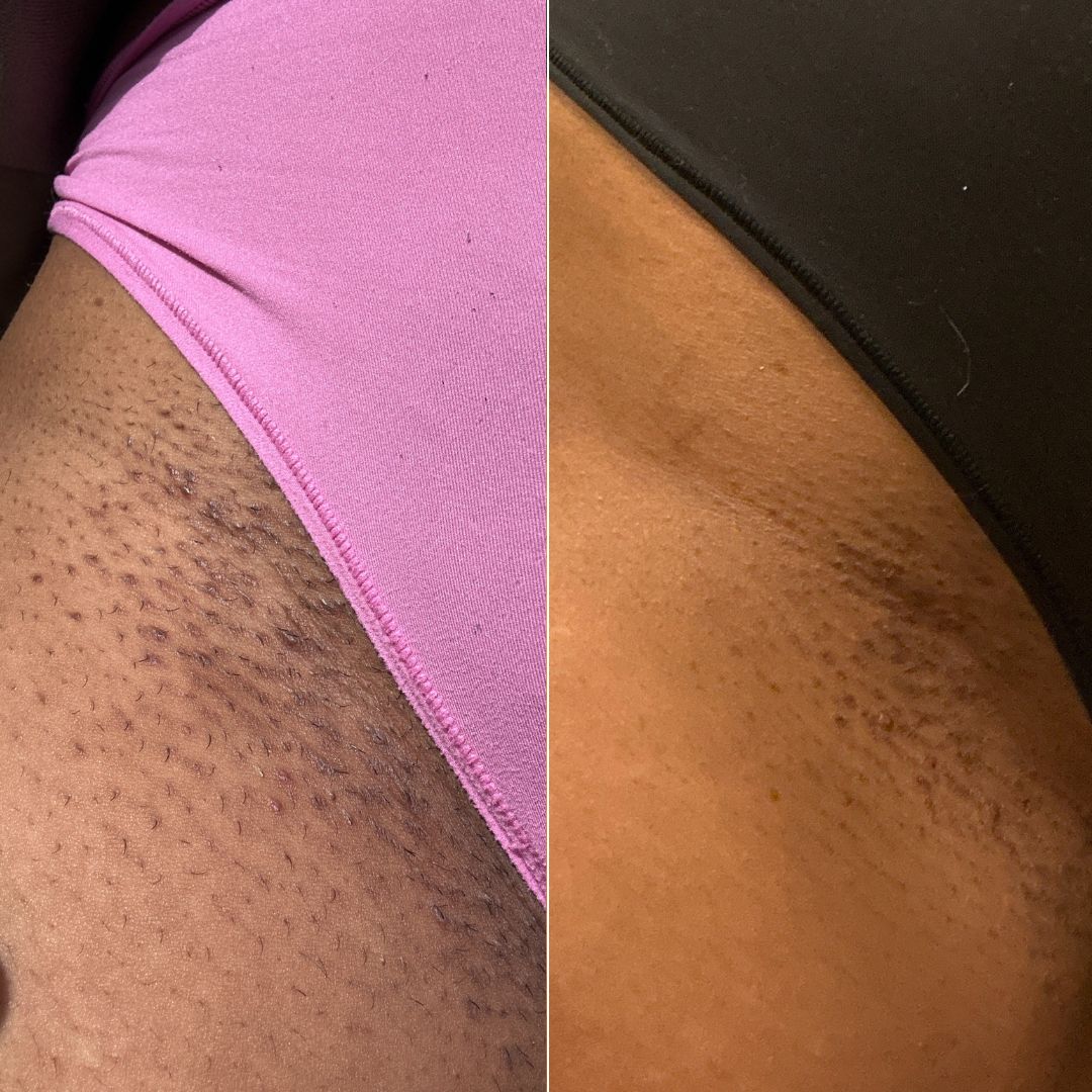 After Dark Bikini Line Brightening Gel Serum results after using Bushbalm