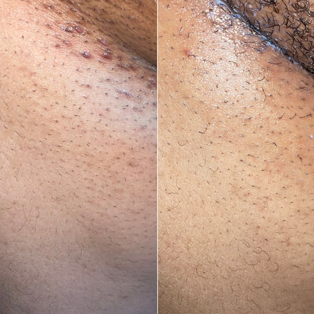 After Dark Bikini Line Brightening Gel Serum results after using Bushbalm