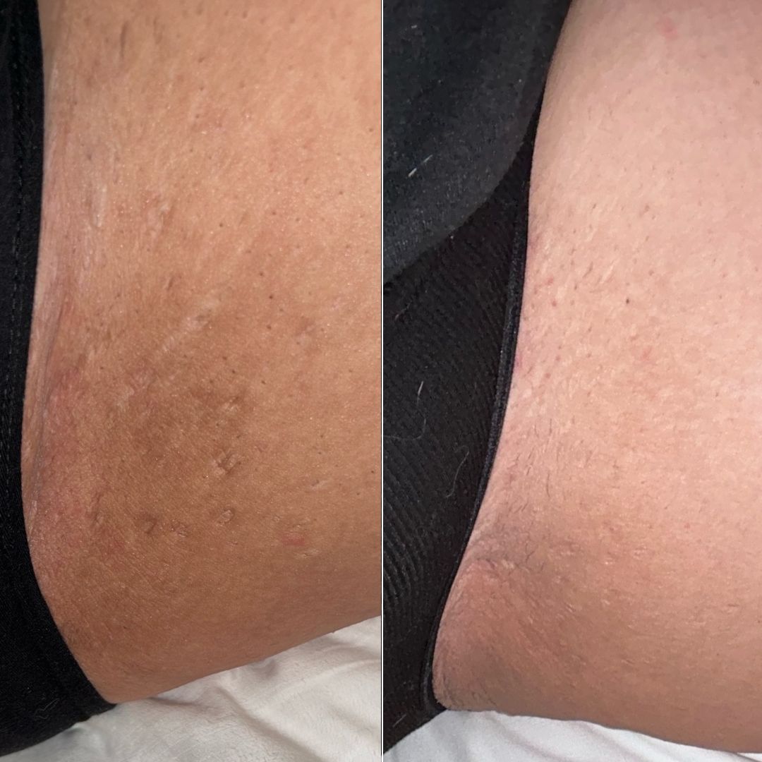 After Dark Bikini Line Brightening Gel Serum results after using Bushbalm