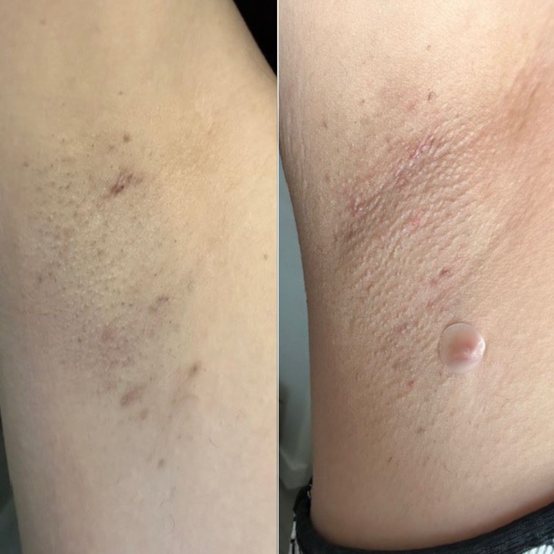 After Dark Underarm Brightening Gel Serum results after using Bushbalm