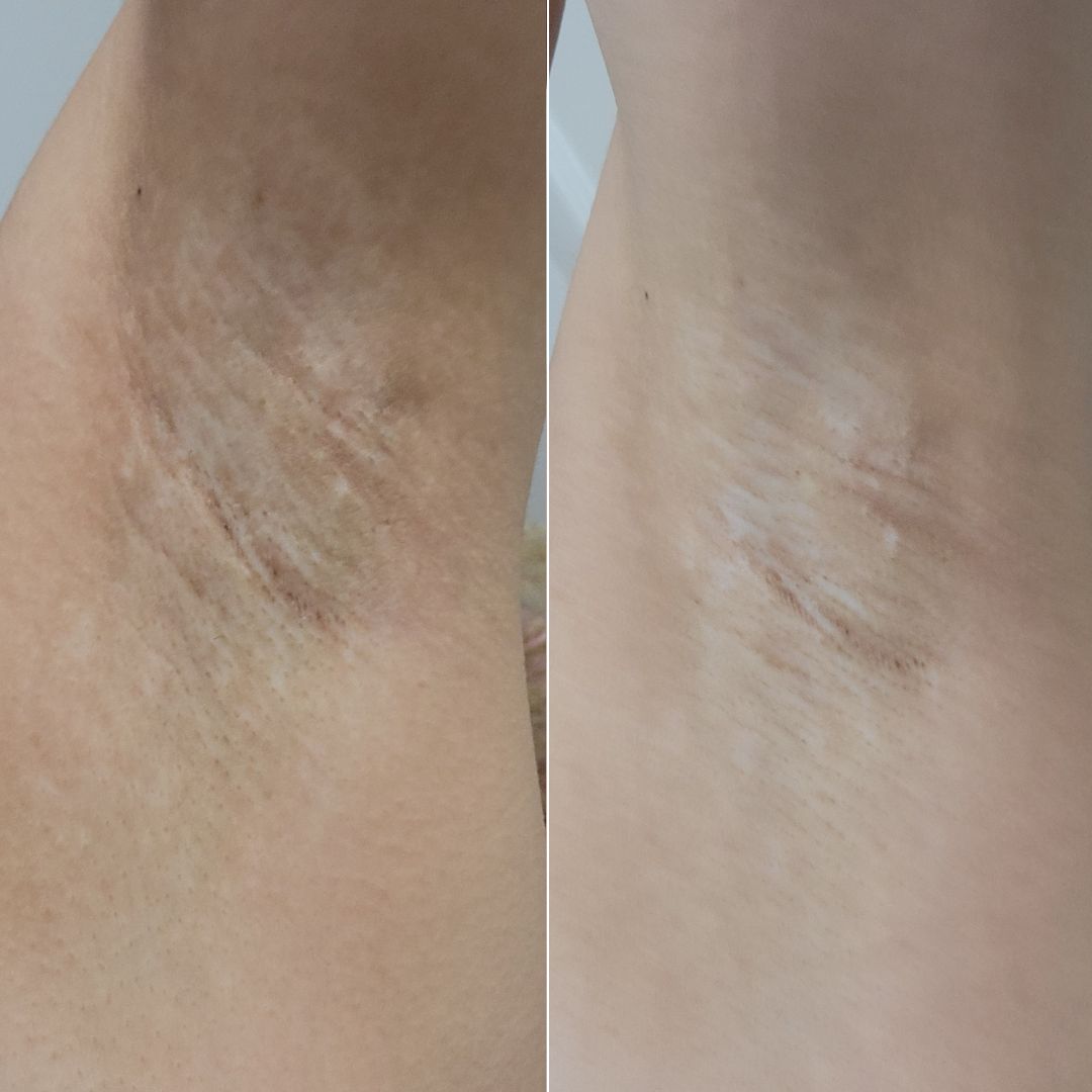 After Dark Underarm Brightening Gel Serum results after using Bushbalm