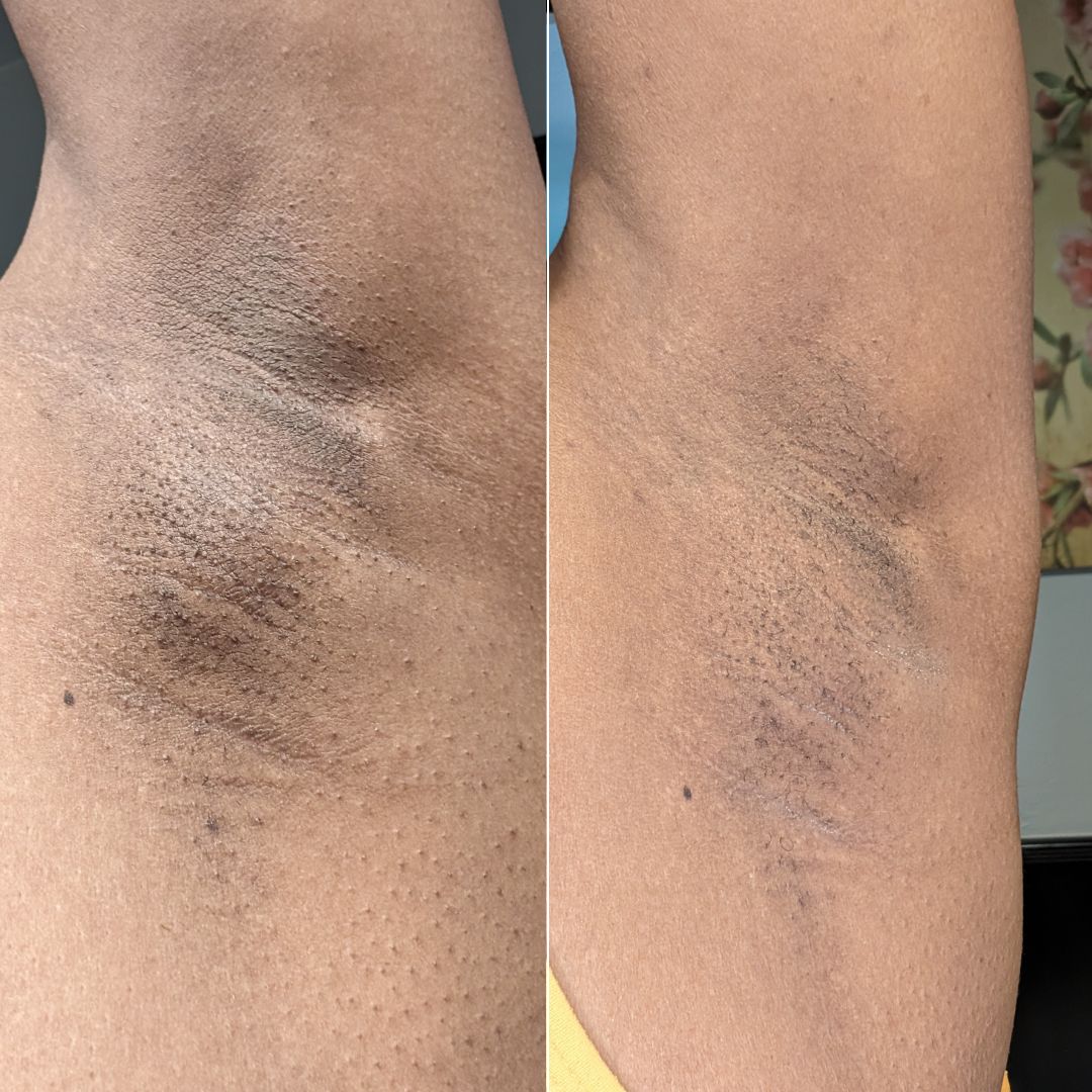 After Dark Underarm Brightening Gel Serum results after using Bushbalm