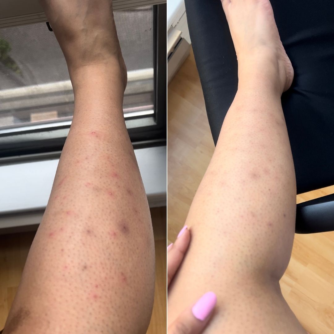 Before and after treating PCOS-related hyperpigmentation and dark spots
