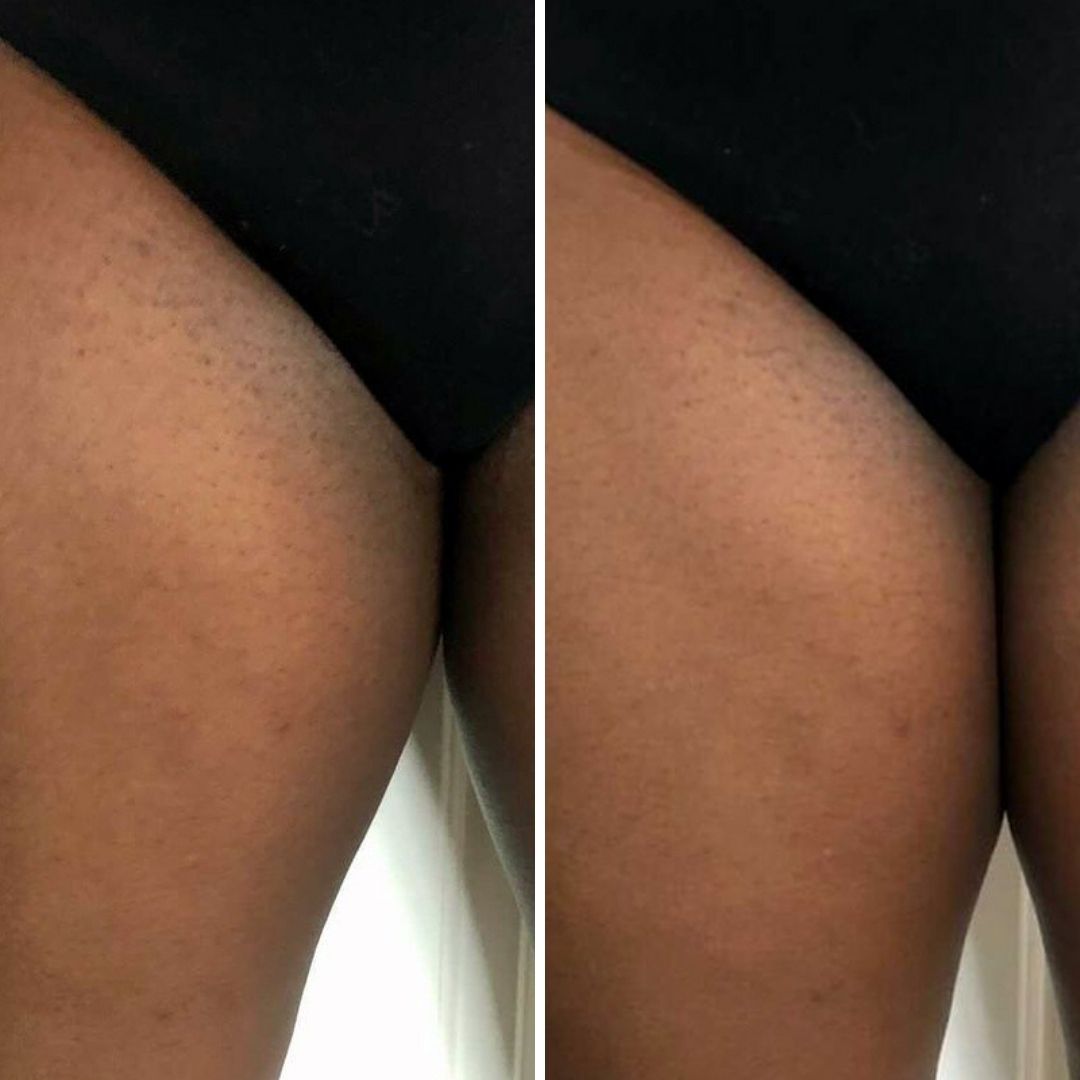 razor bumps bikini line
