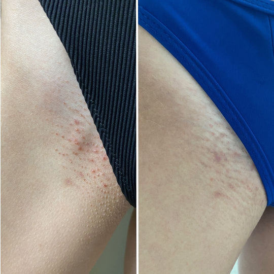 Before and after images of skin irritation on upper thigh areas.