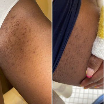 Close-up comparison of skin before and after a treatment, showing improvement in texture and reduction of hyperpigmentation.