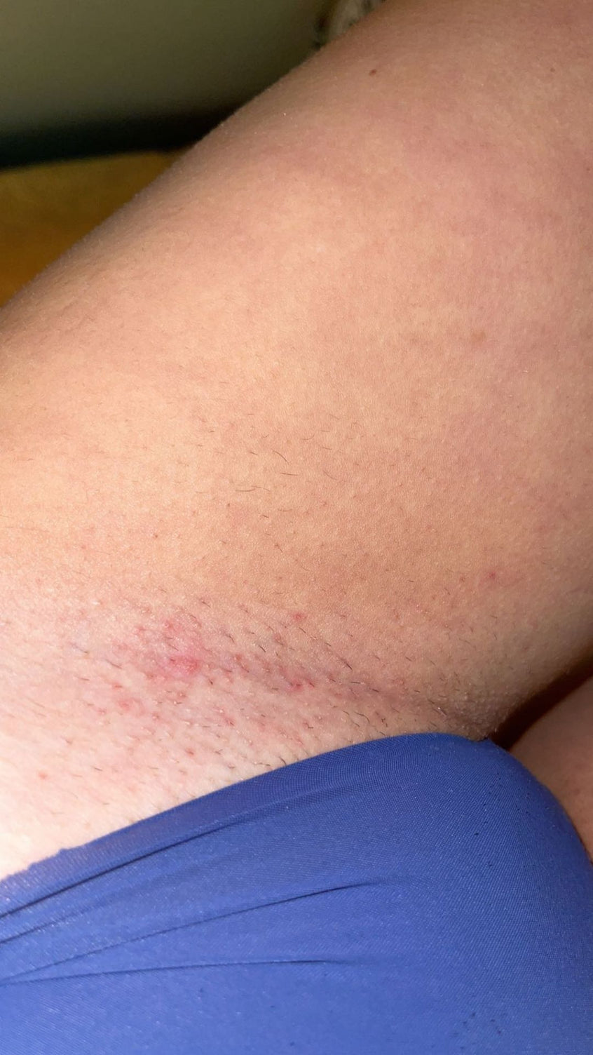 Before and after Bushbalm
