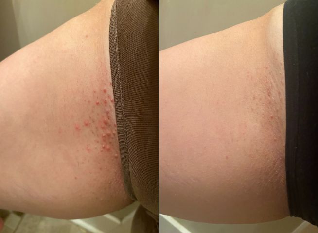 Two side-by-side photos show skin under a waistband: the left image has red bumps, while the right image shows reduced redness and fewer bumps.