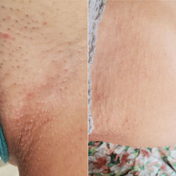 The Ultimate Ingrown Hair Routine - June Offer