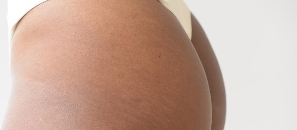 Stretch Marks