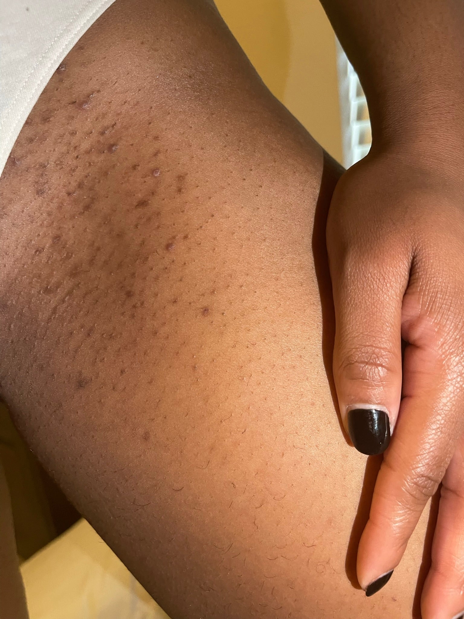 Best Products for Dark Spot Removal on the Bikini Line & Body