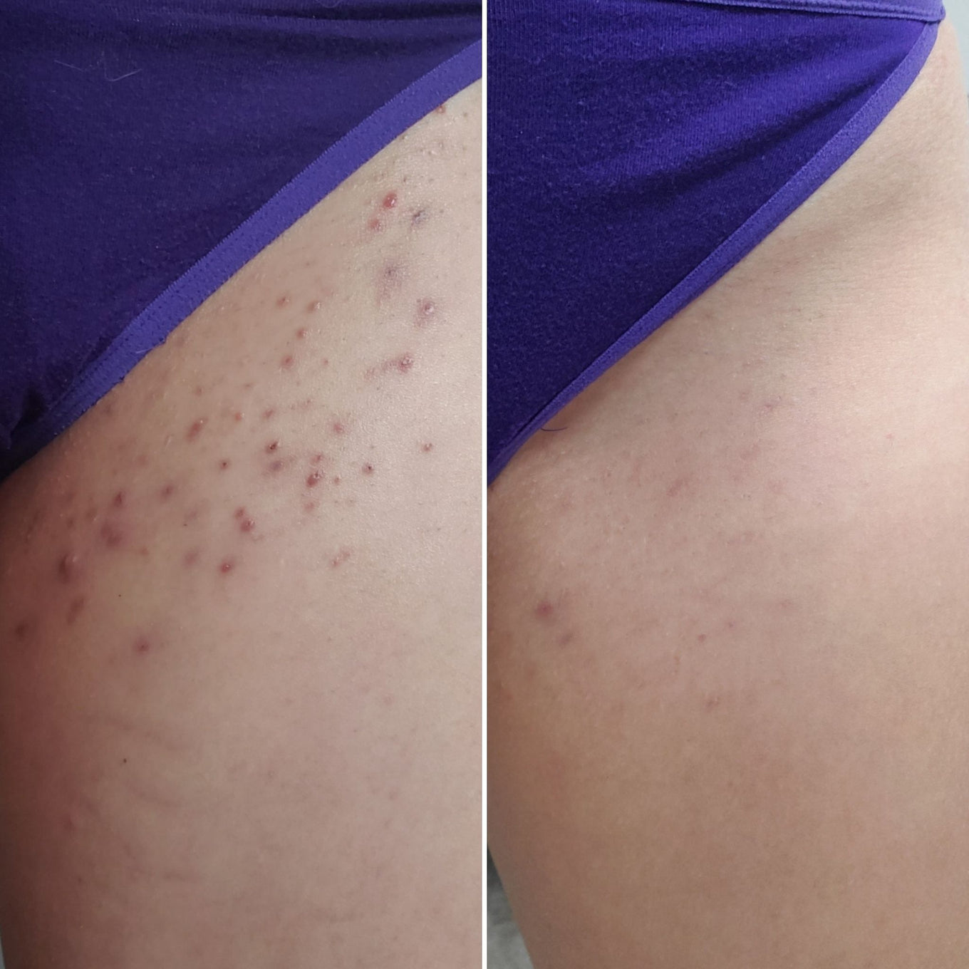 Bikini Line Razor Burn