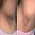 hyperpigmentation in armpit