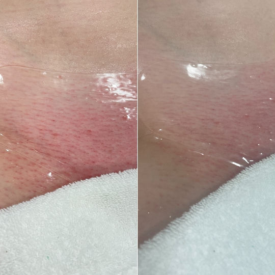 Close-up of skin with visible improvement after treatment, showing before and after comparison.