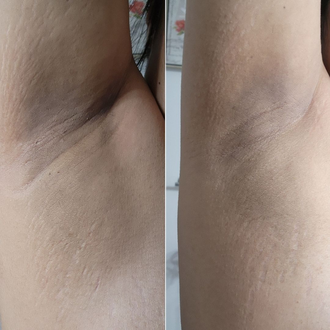 Week Radiant Resent Results on Underarms