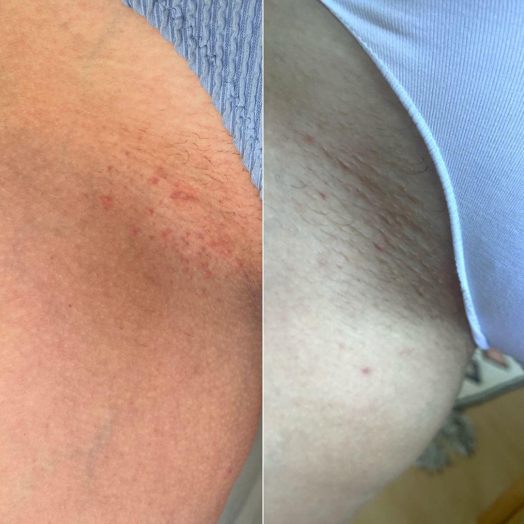 Bikini line before and after, side by side