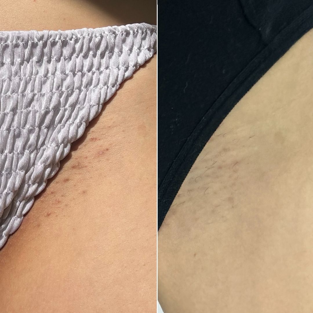 Bikini line before and after in two pairs of underwear