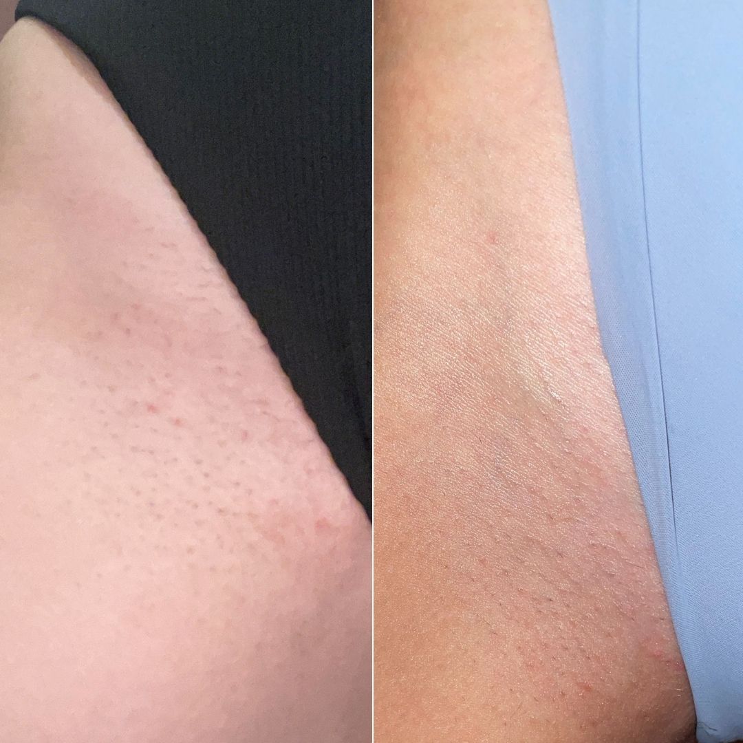 Inner thigh before and after, side by side