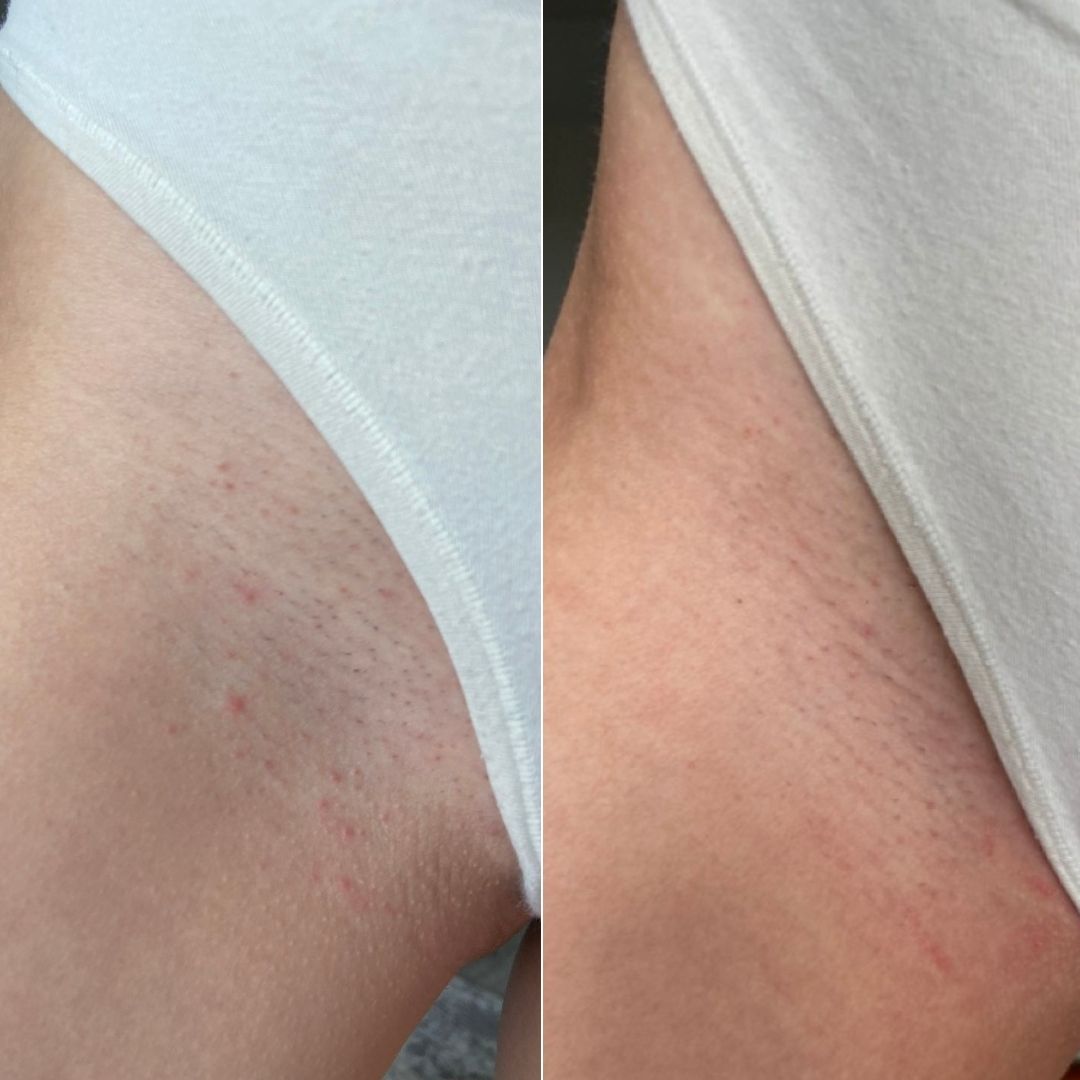 Bikini line before and after, side by side
