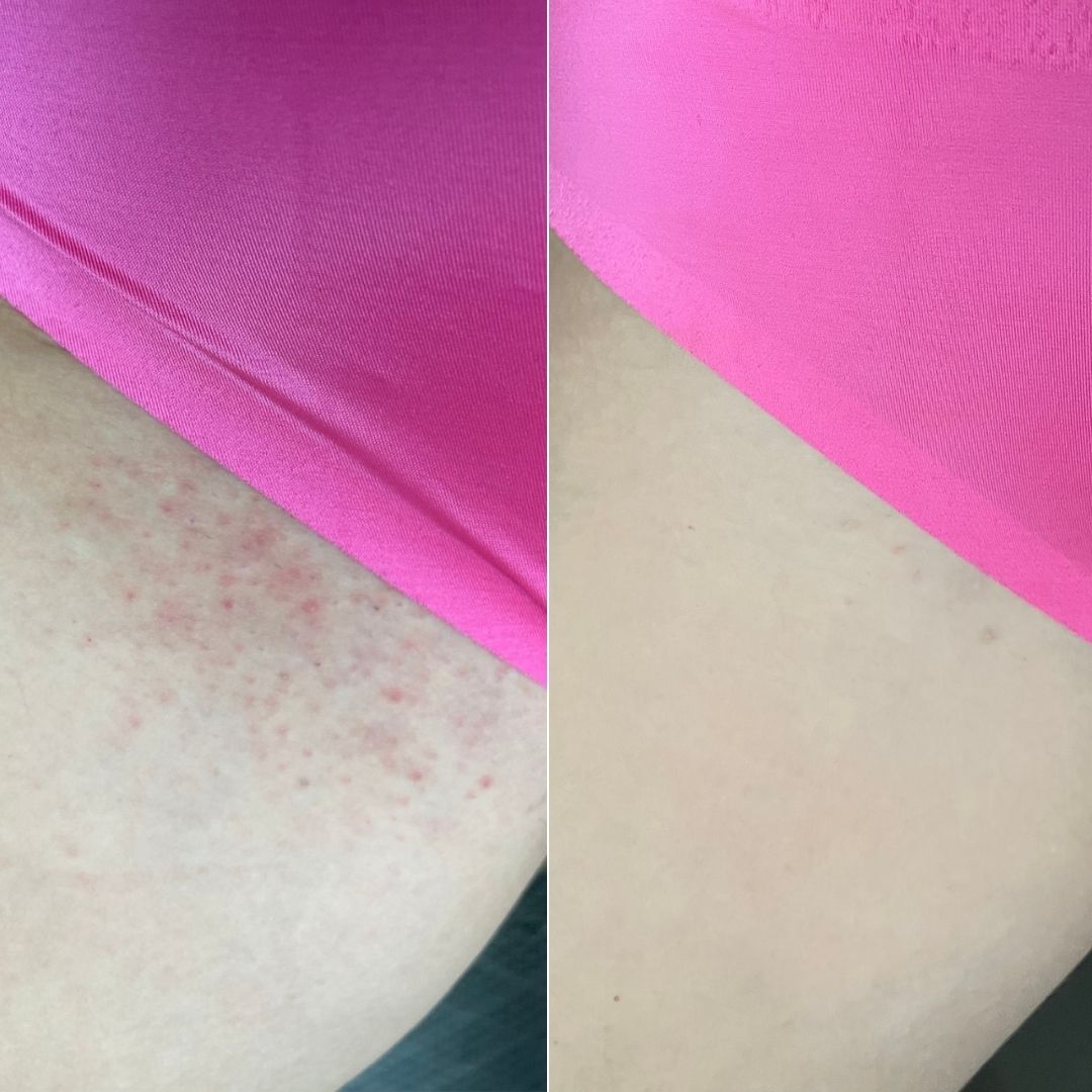 Bikini line before and after, side by side
