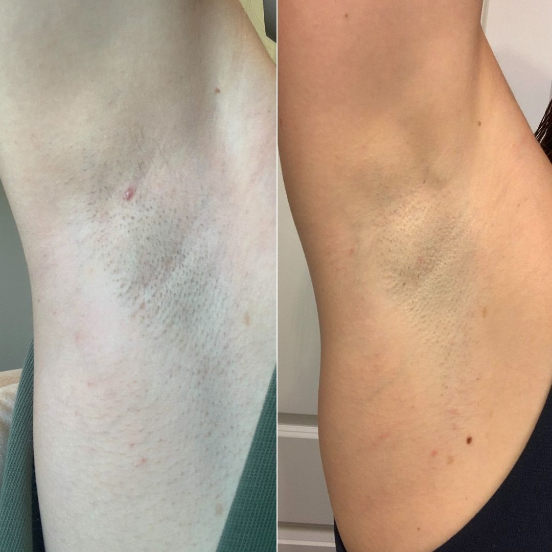 Underarm before and after, side by side