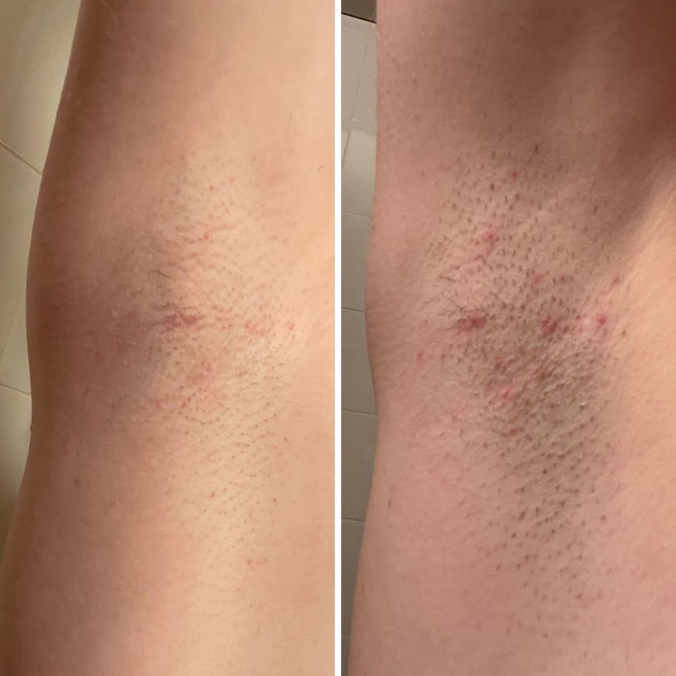 Before and after underarm razor burn