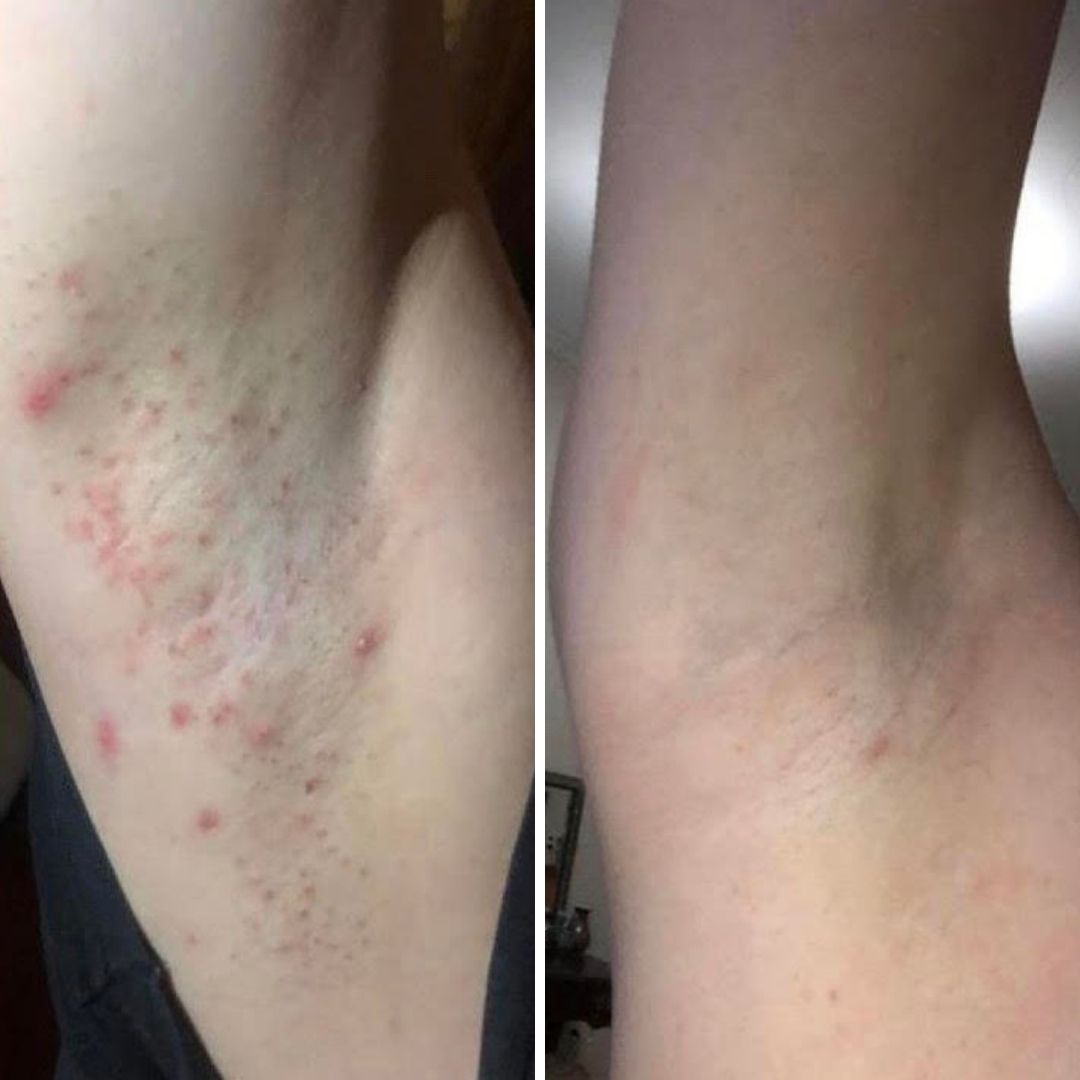 Razor Burn Photos - Library of Close Up Images – Bushbalm