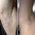 ingrown hair in armpit before and after results bushbalm