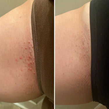 How to get rid deals of ingrown hair scars